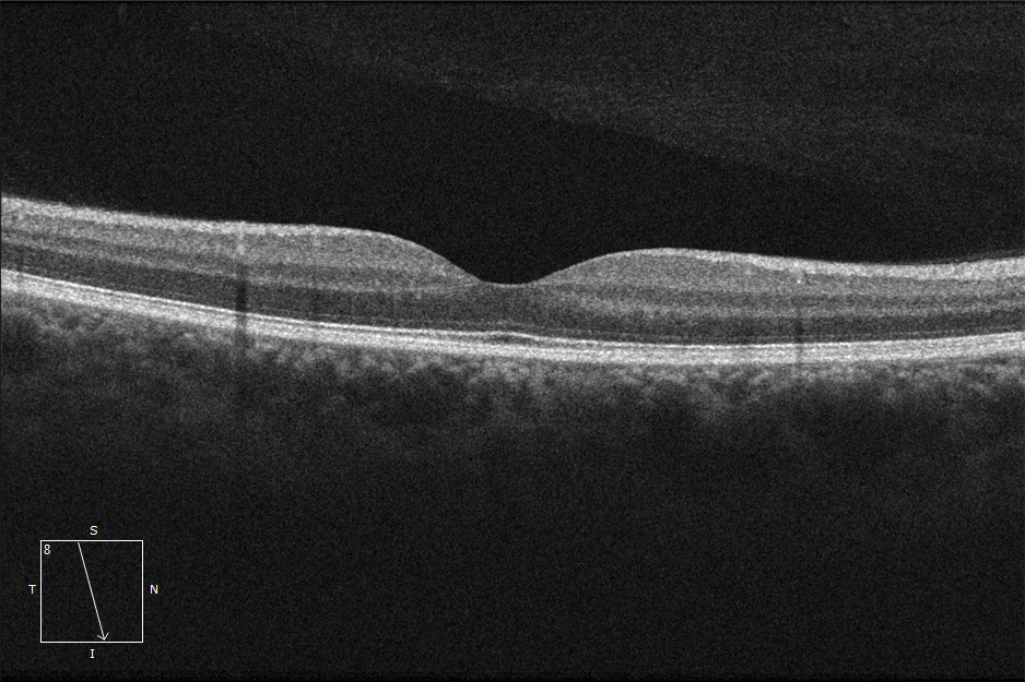 Retina normal